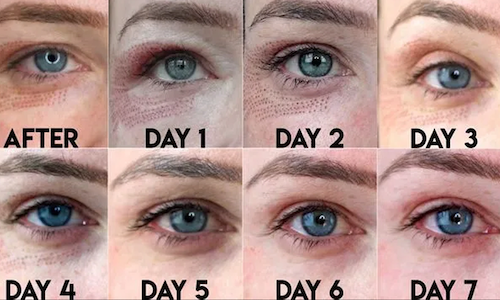 plasma iq pen eye wrinkle treatment before after mississauga oakville